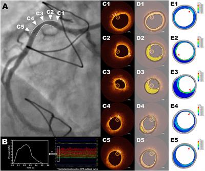 Optical Coherence Tomography-Derived Changes in Plaque Structural Stress Over the Cardiac Cycle: A New Method for Plaque Biomechanical Assessment